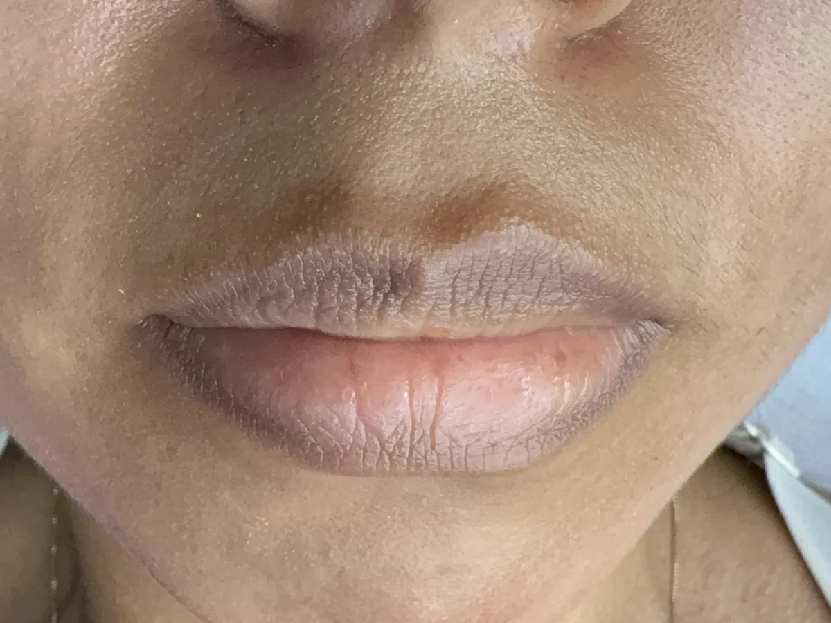Labios antes de la neutralización, con tono oscuro
